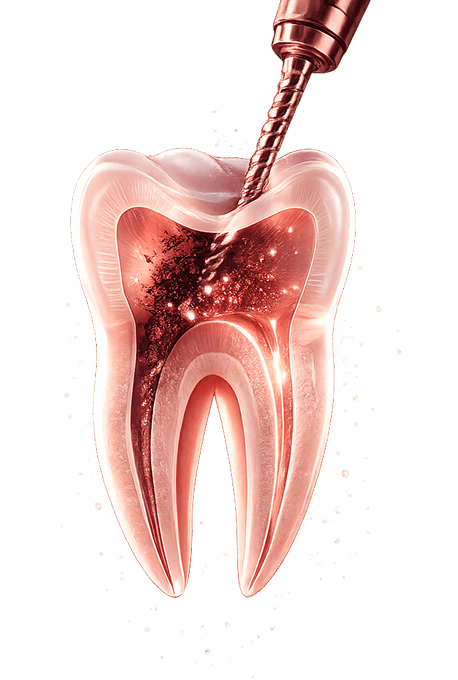 Root Canal Treatment